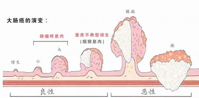 男人头号杀手大肠癌可预防