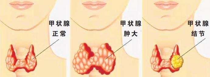 大颈包肿块是癌症体征吗