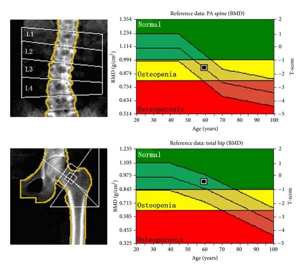 腰椎与股骨部位的DXA 图表