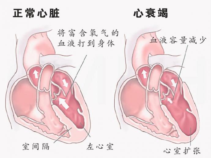 正常心脏 心衰竭 图表