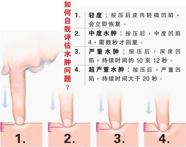 评估水肿 图表