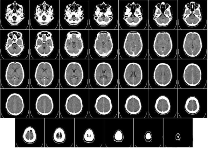 双源电脑断层扫描仪,Dual Source CT Scanner,DSCT扫描仪,