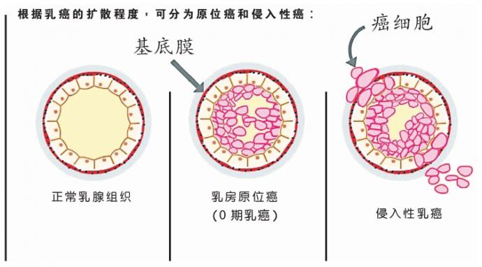 乳癌 图表