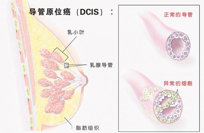 乳癌 图表