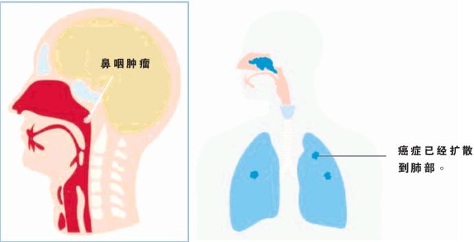 鼻咽 图表