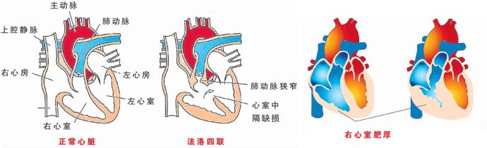 先天性心脏病