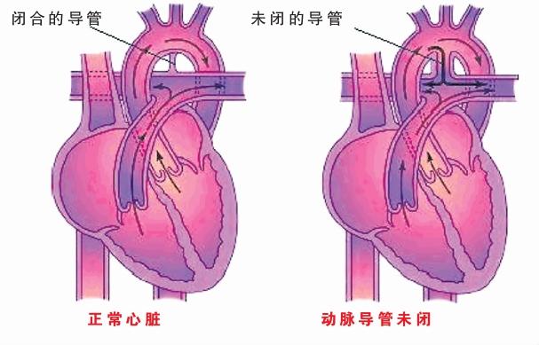 动脉导管未闭