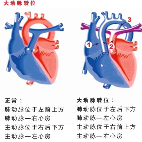 大动脉转位