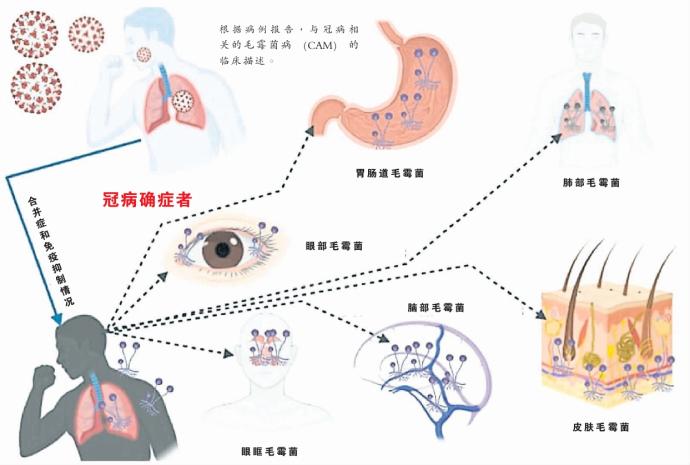 毛霉菌病