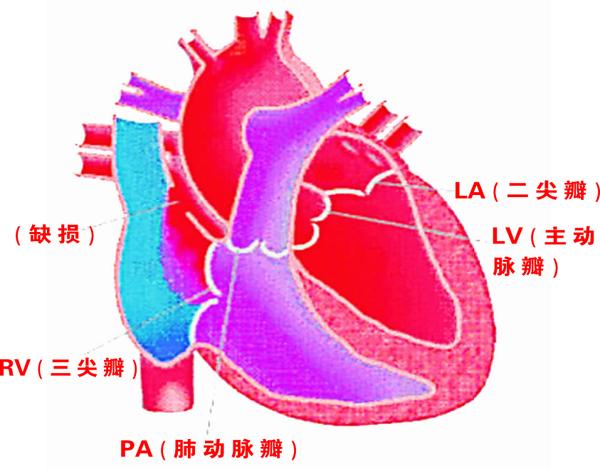 心房间隔缺损