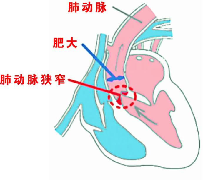 肺动脉狭窄