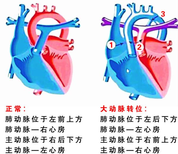 大动脉转位