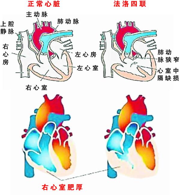 法洛四联症