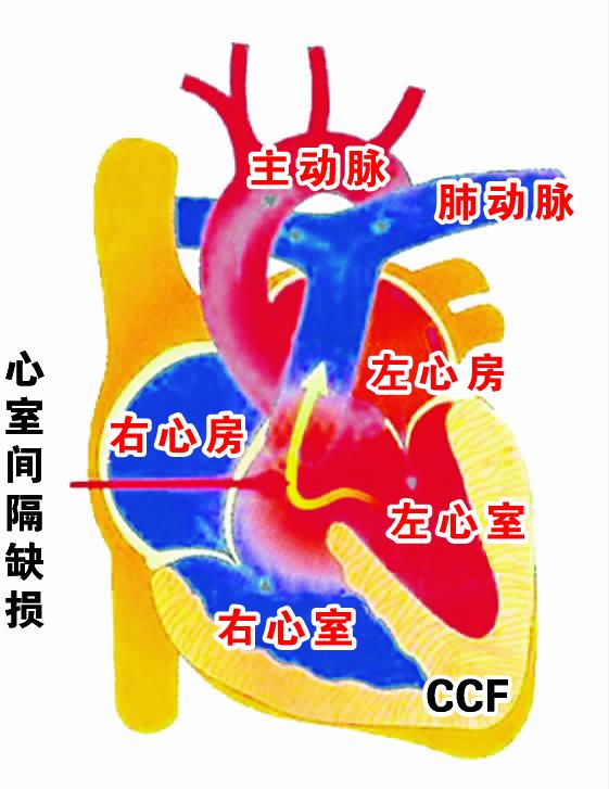 心室间隔缺损