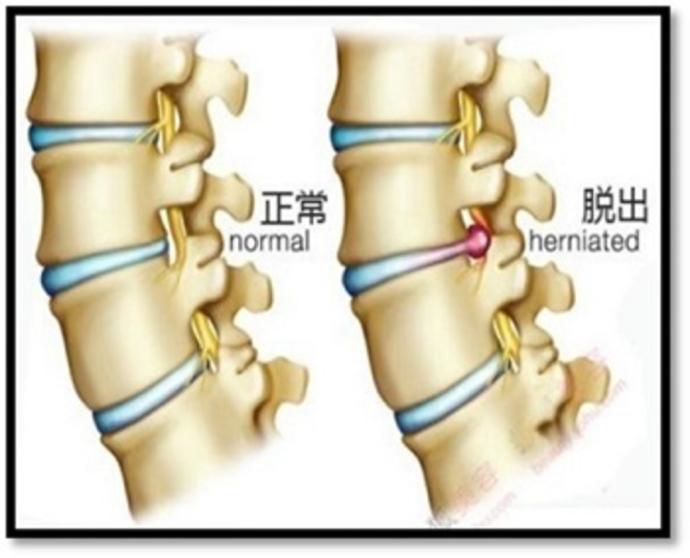 腰椎间盘突出