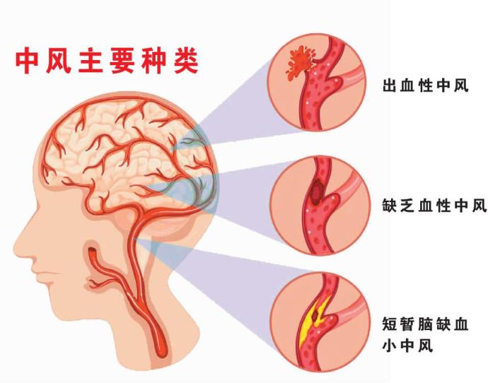 中风主要种类