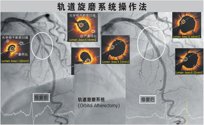 刁伟荣医生 心脏病 轨道旋磨系统操作法