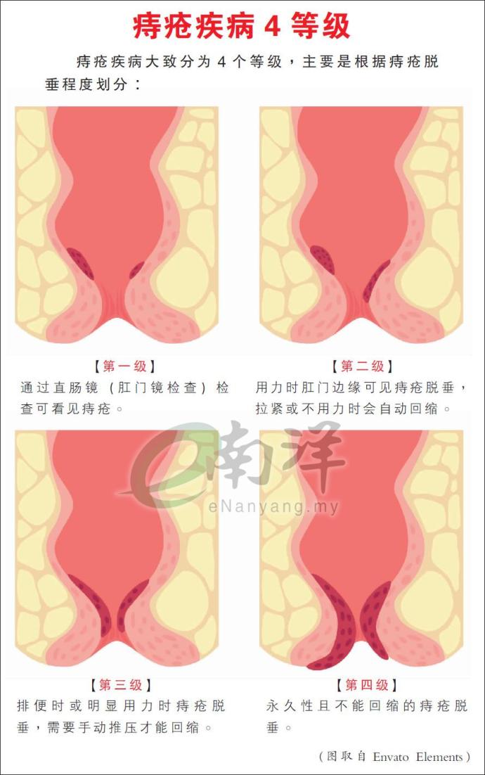 痔疮疾病4等级