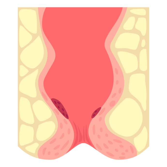 内痔疮