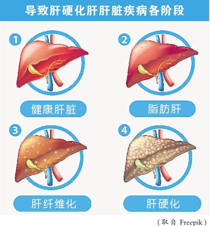 导致肝硬化肝肝脏疾病各阶段