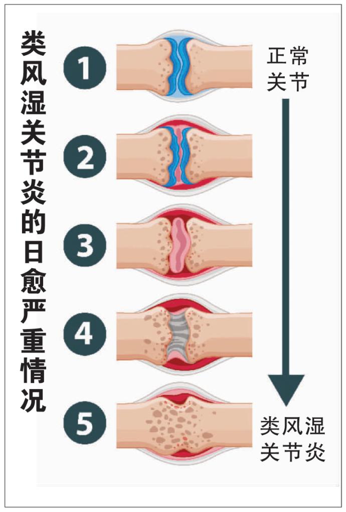 类风湿关节炎的日愈严重情况