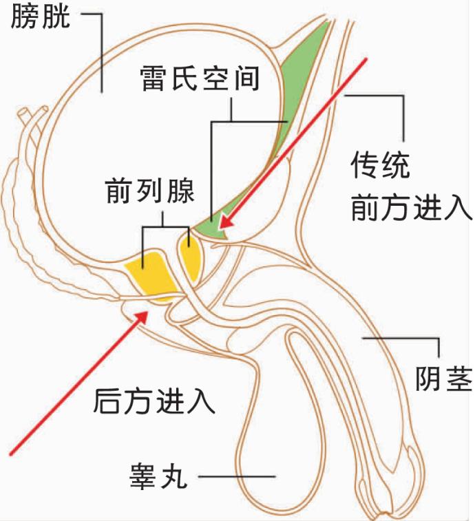 切除前列腺新法