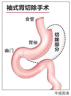 国大医院自2010年开始，为大约20名青少年病人动了袖式胃切除手术。