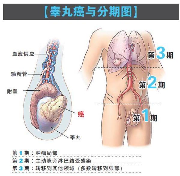 小块状物隐隐作痛 自检睾丸防癌